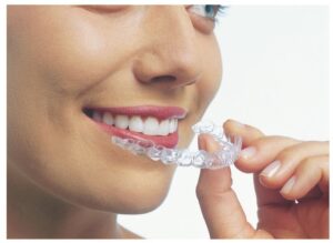 invisalign up close